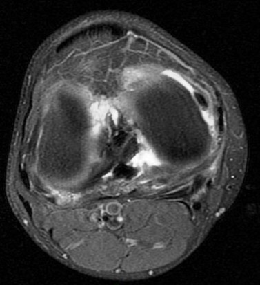 Figure 4 for case Unstable flap tear, medial meniscus